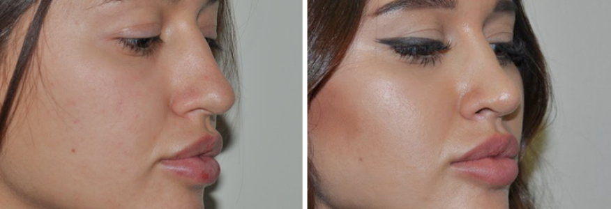 Ринопластика 