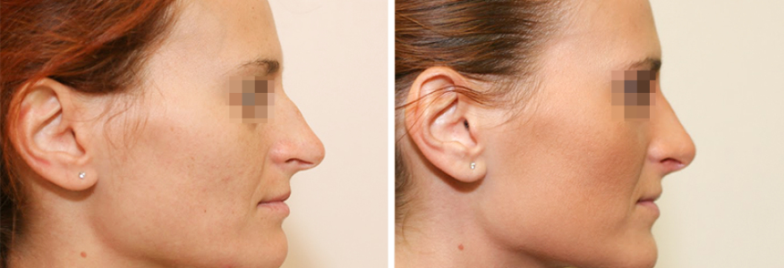 Ринопластика 