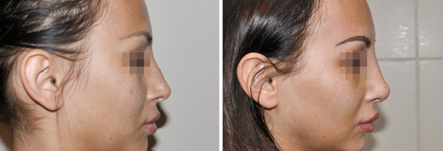 Ринопластика 