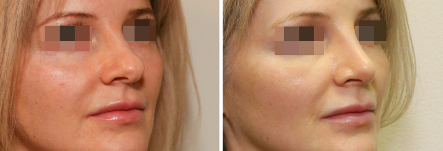 Ринопластика 