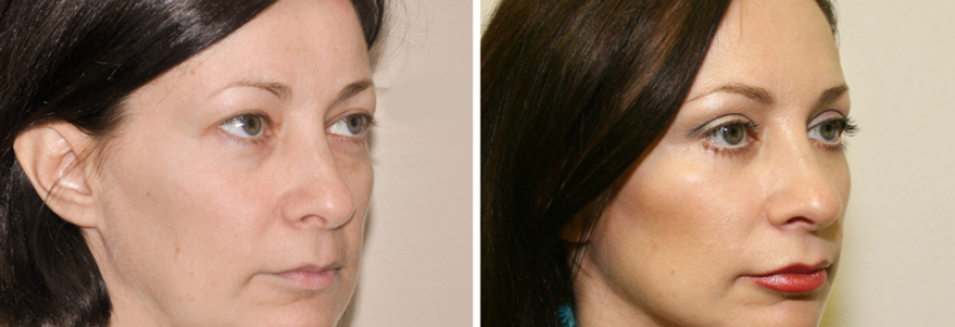 Фейслифтинг