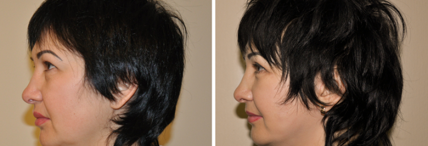Фейслифтинг