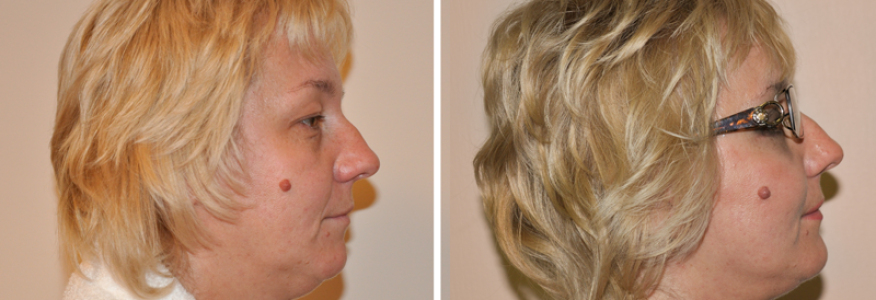 Фейслифтинг