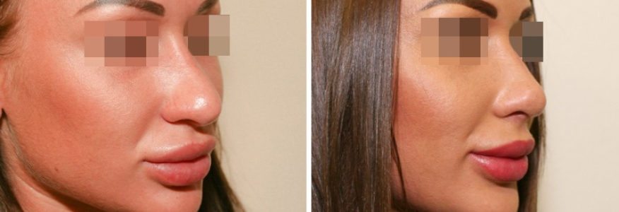 Ринопластика 