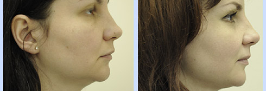 Пластика лица