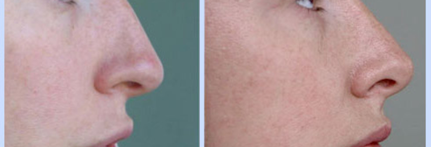 Ринопластика 