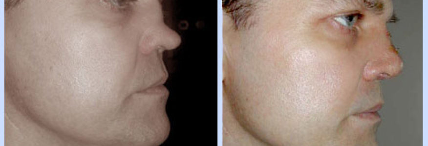 Ринопластика 