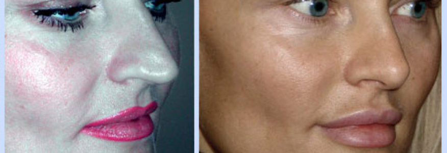 Ринопластика 