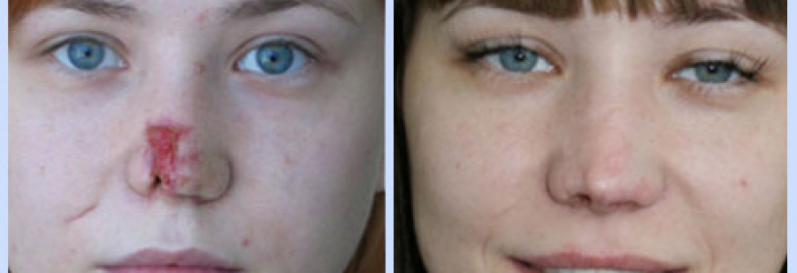 Ринопластика реконструктивная