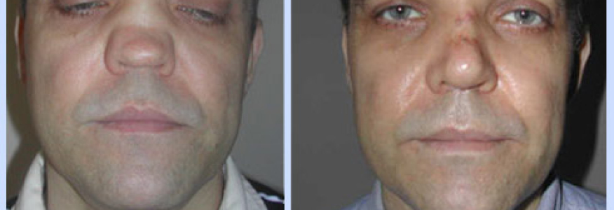 Ринопластика 