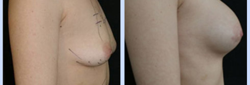 Маммопластика