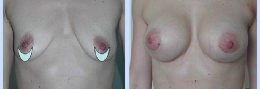 Маммопластика