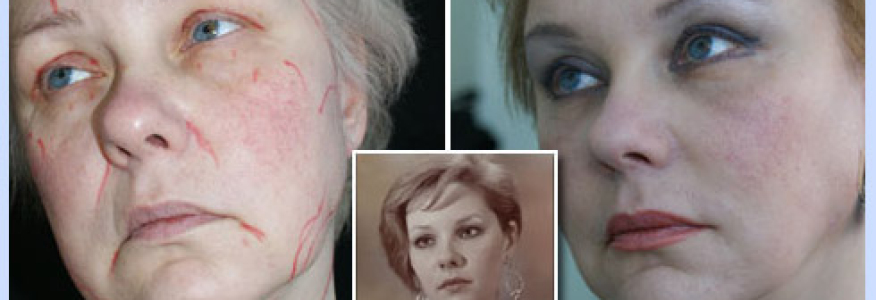 Подтяжка лица