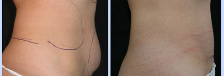 Абдоминопластика+липосакция
