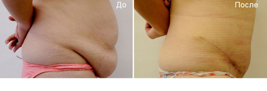 Абдоминопластика