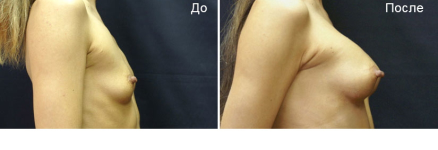 Маммопластика