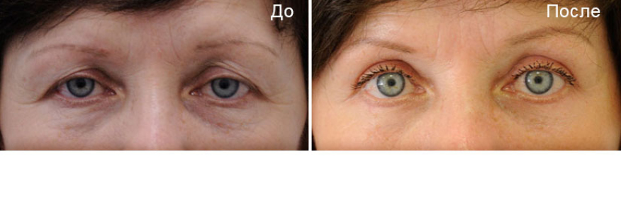 Блефаропластика