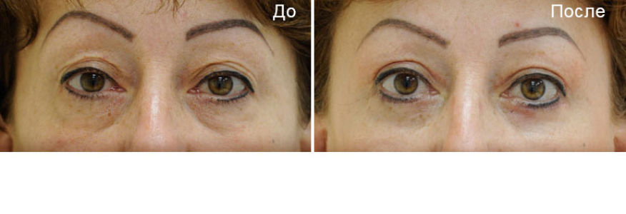 Блефаропластика