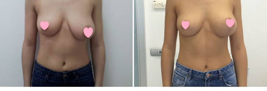 Подтяжка груди