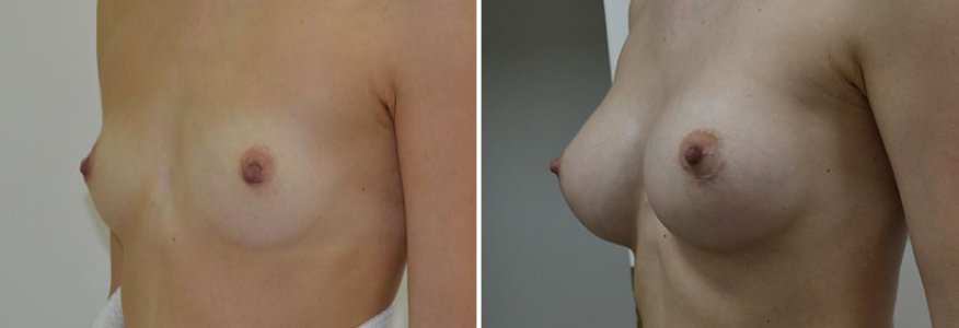 Увеличение груди