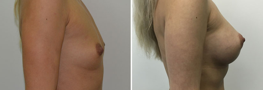 Увеличение груди