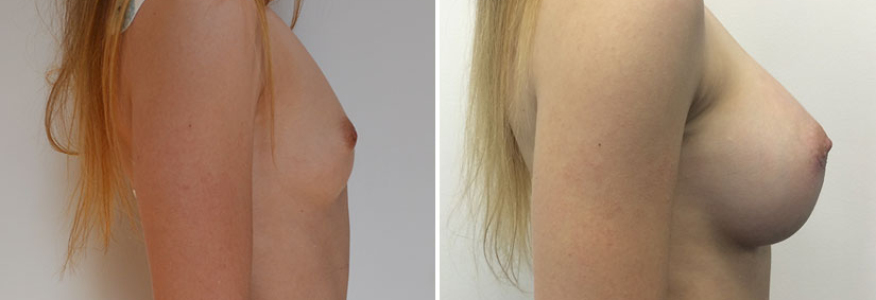 Увеличение груди