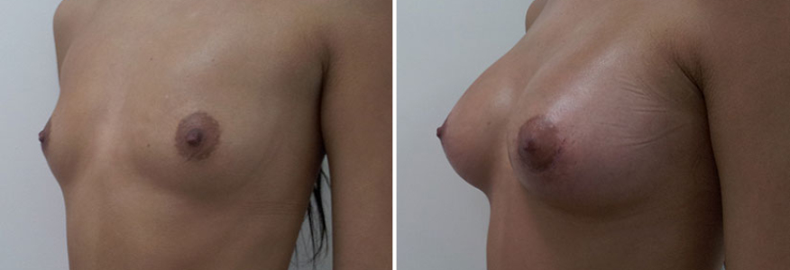 Увеличение груди