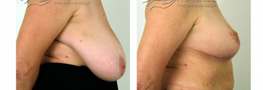 КОРРЕКЦИЯ ГИГАНТОМАСТИИ