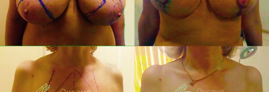 УМЕНЬШЕНИЕ ГРУДИ, 2 НЕДЕЛИ ПОСЛЕ ОПЕРАЦИИ