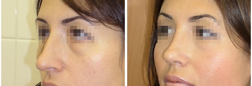 Ринопластика