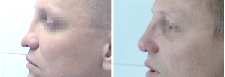 Ринопластика