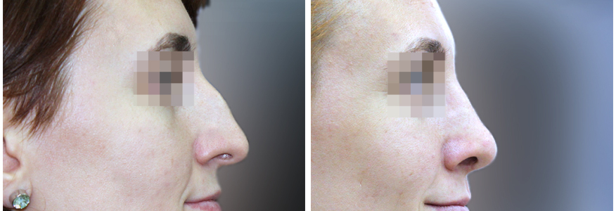 Ринопластика