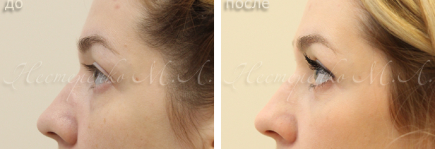 Фото пациентки на 12 сутки после операции, были жалобы на грыжи под глазами. Выполнена трансконъюнктивальная нижняя блефаропластика (без разреза на коже).