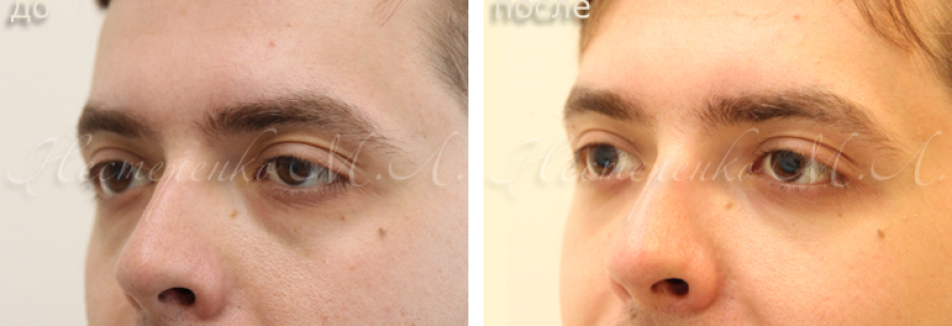 Фото до и через 10 дней после трансконъюнктивальной блефаропластики нижних век (без разреза на коже)