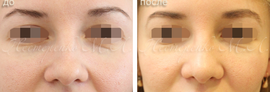 Пациентке выполнена ринопластика.
Состояние через 6 месяца после операции.