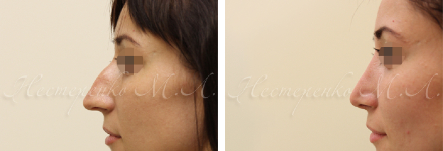 Пациентке выполнена ринопластика.
Состояние через 4 месяца после операции.