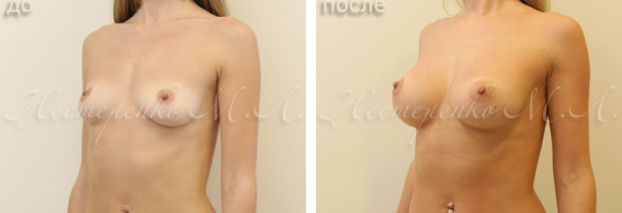 Пациентке установлены круглые имплантаты Allergan Natrelle TRF365.
На фото пациентка до и через 1 год после операции.
Отмечается изначальная незначительная асимметрия ареол (правая ниже левой), пациентку это не беспокоит. На фото после отмечается аналогичная асимметрия, для ее устранения необходима коррекция ареол, от которой пациентка отказалась.