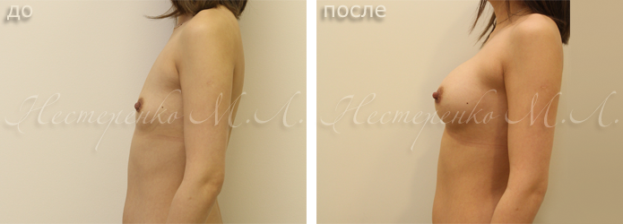 Пациентке установлены анатомические имплантаты Allergan Natrelle МF 335 г, рост 160 см, грудная клетка 71 см. 
Фото пациентки через 3 месяца после операции.


