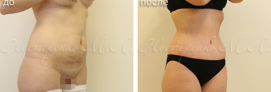 Фото пациентки до и через 6 месяцев после абдоминопластики. Устранен диастаз (расхождение) прямых мышц живота. Появилась талия.