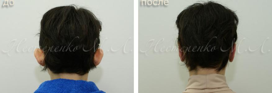 Фото пациентки до и после пластики ушей.