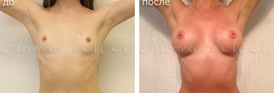 Пациентке установлены круглые имплантаты Allergan Natrelle TSM275, через разрез под грудью (субмаммарный доступ), рост пациентки 160 см, грудная клетка 67 см. 
Фото до и 6 месяцев после операции.