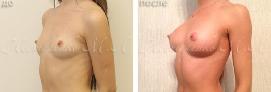Пациентке установлены круглые имплантаты Allergan Natrelle TSM275, через разрез под грудью (субмаммарный доступ), рост пациентки 160 см, грудная клетка 67 см. 
Фото до и 6 месяцев после операции.