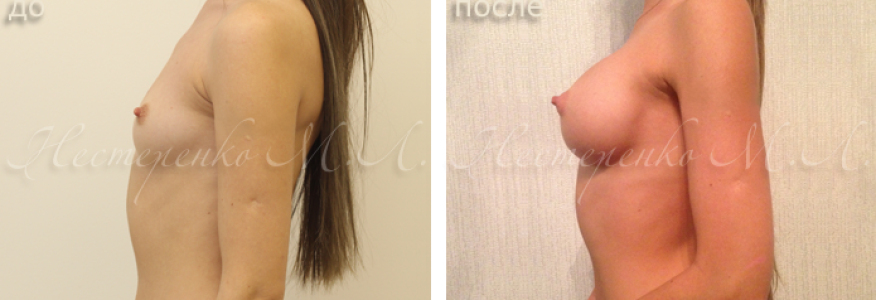 Пациентке установлены круглые имплантаты Allergan Natrelle TSM275, через разрез под грудью (субмаммарный доступ), рост пациентки 160 см, грудная клетка 67 см. 
Фото до и 6 месяцев после операции.