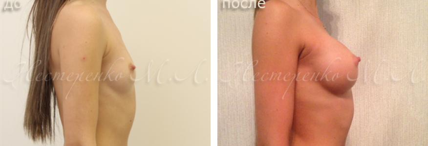 Пациентке установлены круглые имплантаты Allergan Natrelle TSM275, через разрез под грудью (субмаммарный доступ), рост пациентки 160 см, грудная клетка 67 см. 
Фото до и 6 месяцев после операции.