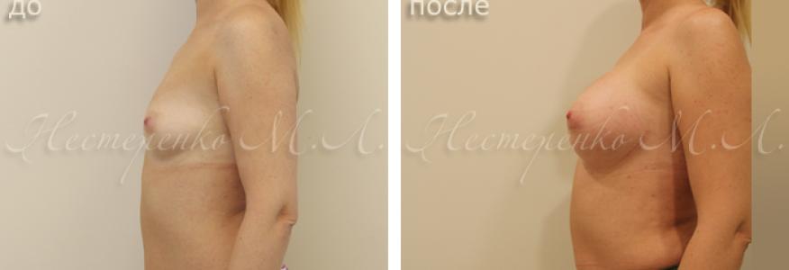 Пациентке установлены имплантаты Allergan Natrelle MF375, рост пациентки 165 см. 
На фото пациентка до и через 5 месяцев после операции.