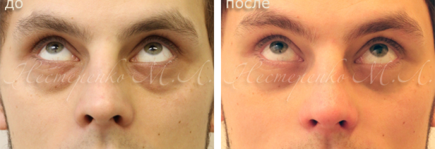 Пациент 25 лет. Фото до и через 9 дней после трансконъюнктивальной блефаропластики нижних век (без разреза на коже).