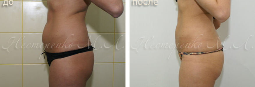 Фото пациентки до и после липосакции живота.