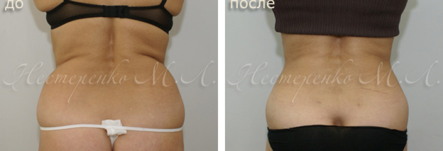 Фото пациентки до и после липосакции талии и боков.