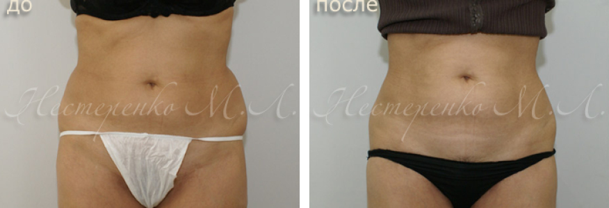 Фото пациентки до и после липосакции талии и боков.