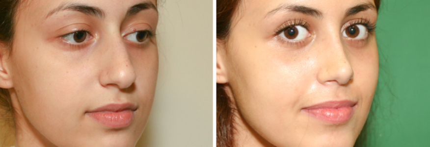 Ринопластика 